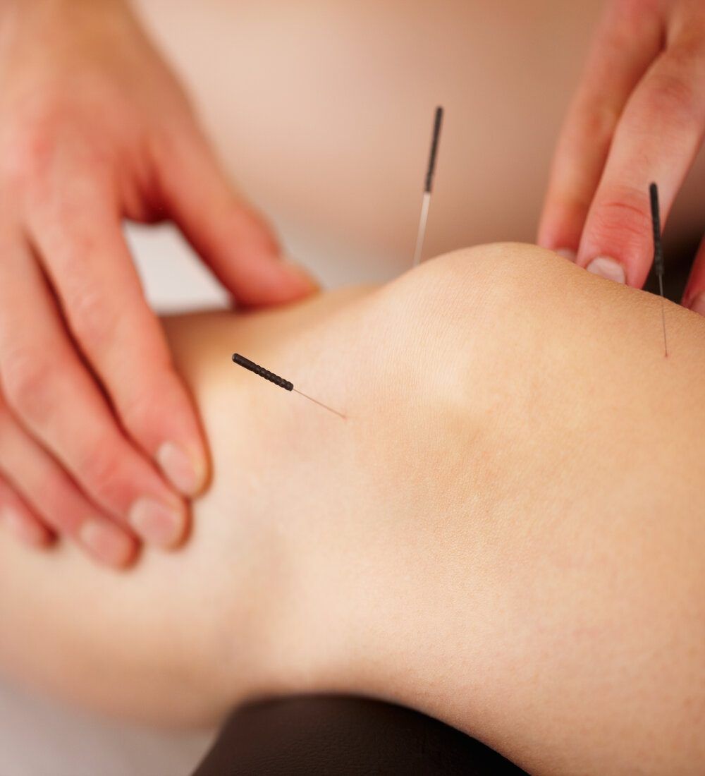 Acupuncture & Dry Needling